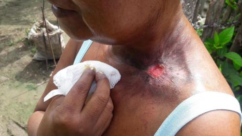 Carcinoma de células basales