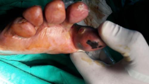 Melanoma maligno e grueso artejo derecho