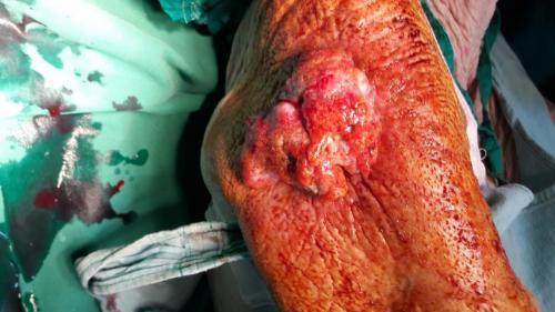 Carcinoma epidermoides del brazo derecho