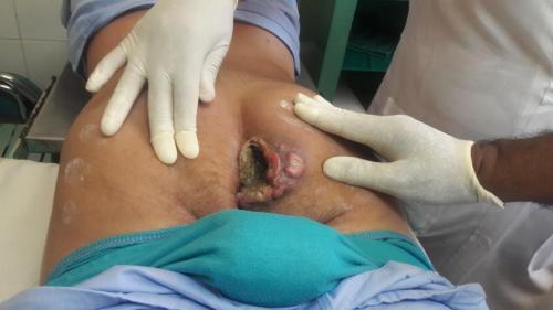 Liposarcoma glúteo derecho