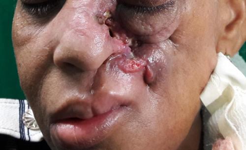 Carcinoma de células basales facial extenso