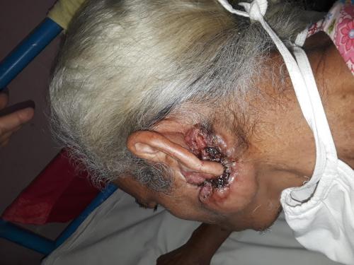 Carcinosarcoma sobre adenoma pleomórfico parotídeo izquierdo