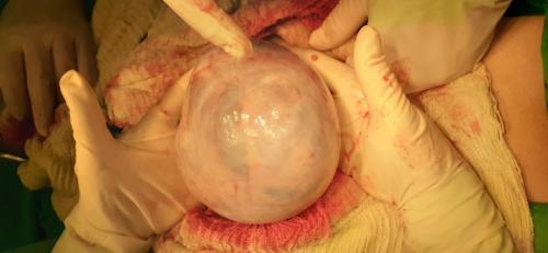 Cistadenocarcinoma ovario derecho