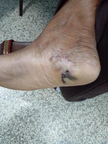 Melanoma maligno plantar derecho