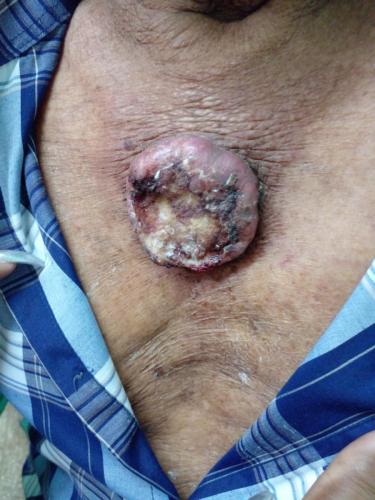 Carcinoma epidermoides