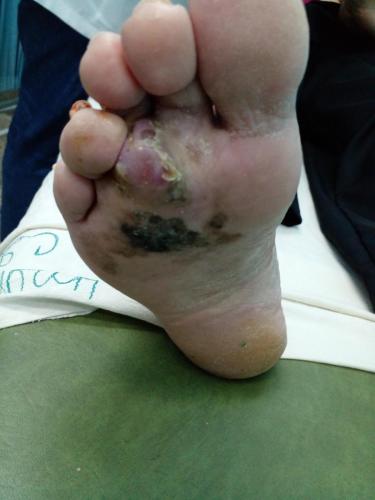 Melanoma plantar 
