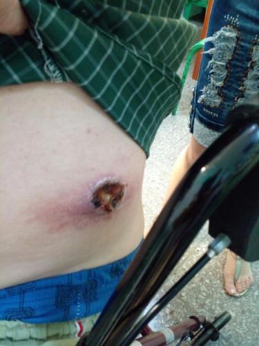 Carcinoma de células basales pared abdominal lateral izquierda