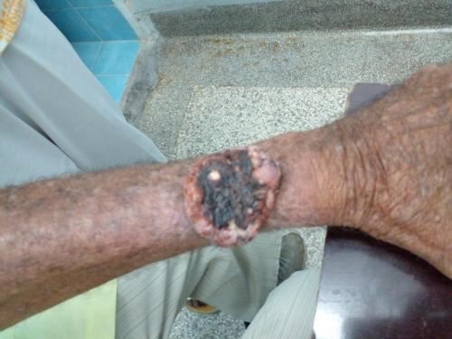 Carcinoma de células basales en antebrazo izquierdo