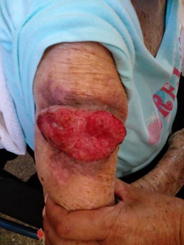 Carcinoma de células basales en codo derecho