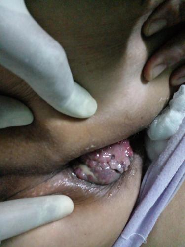Liposarcoma glúteo derecho
