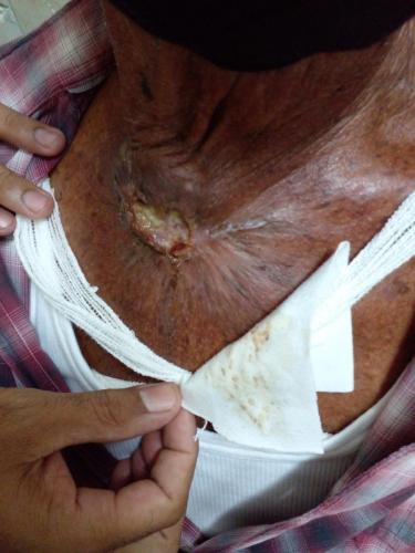 Carcinoma de células basales