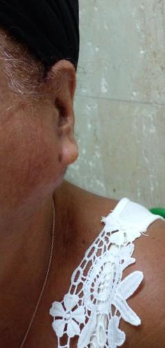 Cistoadenocarcinoma parotídeo izquierdo