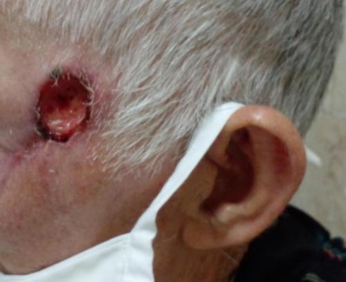 Carcinoma de células basales facial