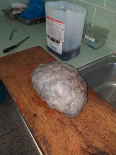 Tumor de Krukenberg izquierdo (es una metástasis ovárica, no es tumor primario)