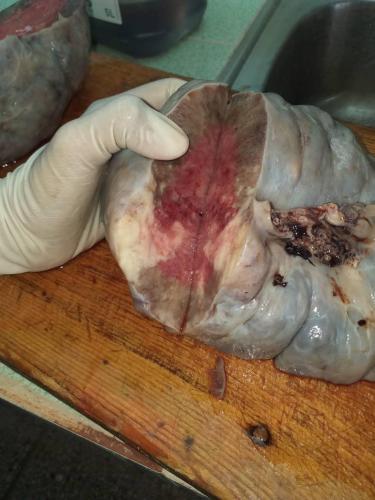 Tumor de Krukenberg izquierdo