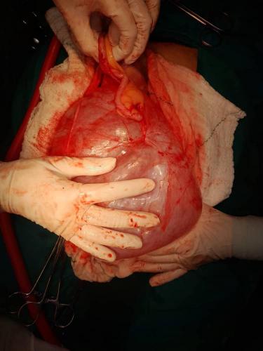 Cistadenocarcinoma ovario derecho