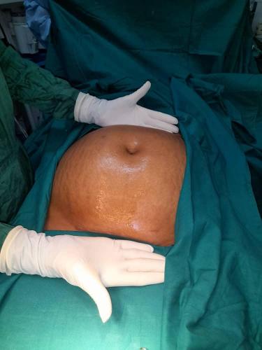 Cistadenocarcinoma ovario derecho (ocupa casi toda la cavidad abdominal)