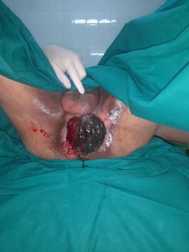 Fibrohistiocitoma maligno del periné con extensión a ambos glúteos