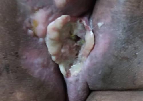 Fibrohistiocitoma maligno del periné con extensión a ambos glúteos