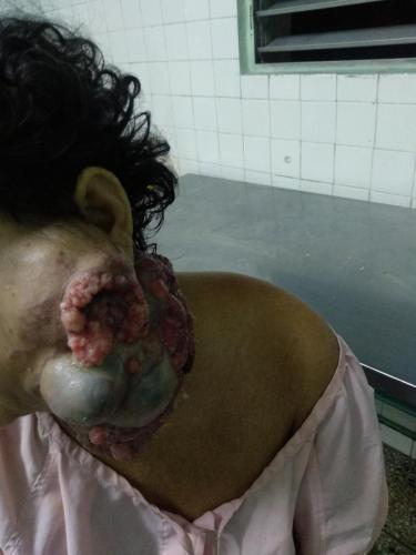 Cistoadenosarcoma parotídeo izquierdo