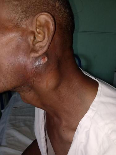 Adenocarcinoma parotídeo izquierdo con infiltración ganglionar regional
