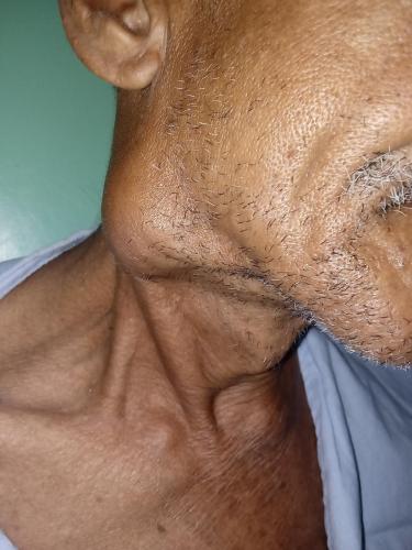 Cistadenocarcinoma parotídeo derecho