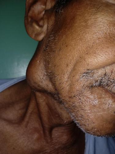 Cistadenocarcinoma parotídeo derecho