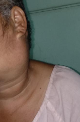 Cistadenocarcinoma parotídeo izquierdo