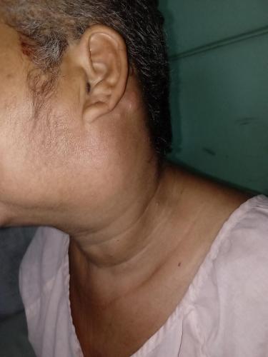 Cistadenocarcinoma parotídeo izquierdo